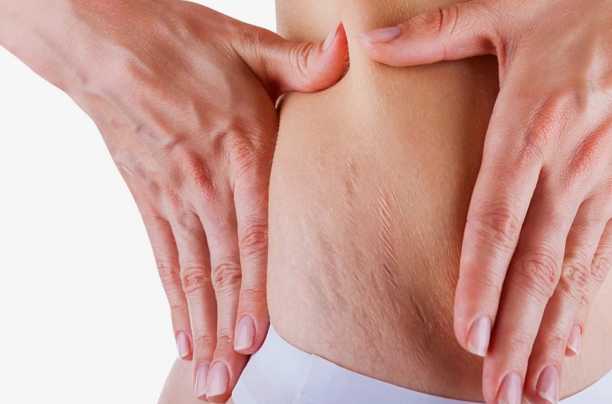 Vücut Çatlakları İçin Bitkisel Çözümler 2023 1 Vücut Çatlakları İçin Bitkisel Çözümler 2021